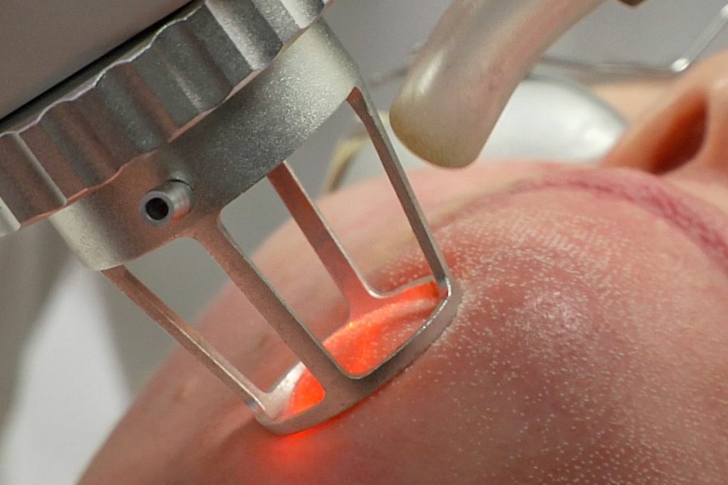 Study Reveals Nordlys Laser Alters DNA Methylation in Human Skin