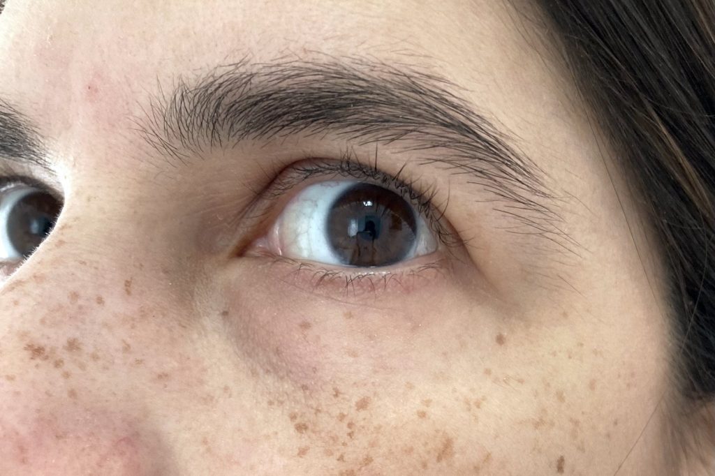 Freckles Are Not Flaws: What Psychology and Science Say
